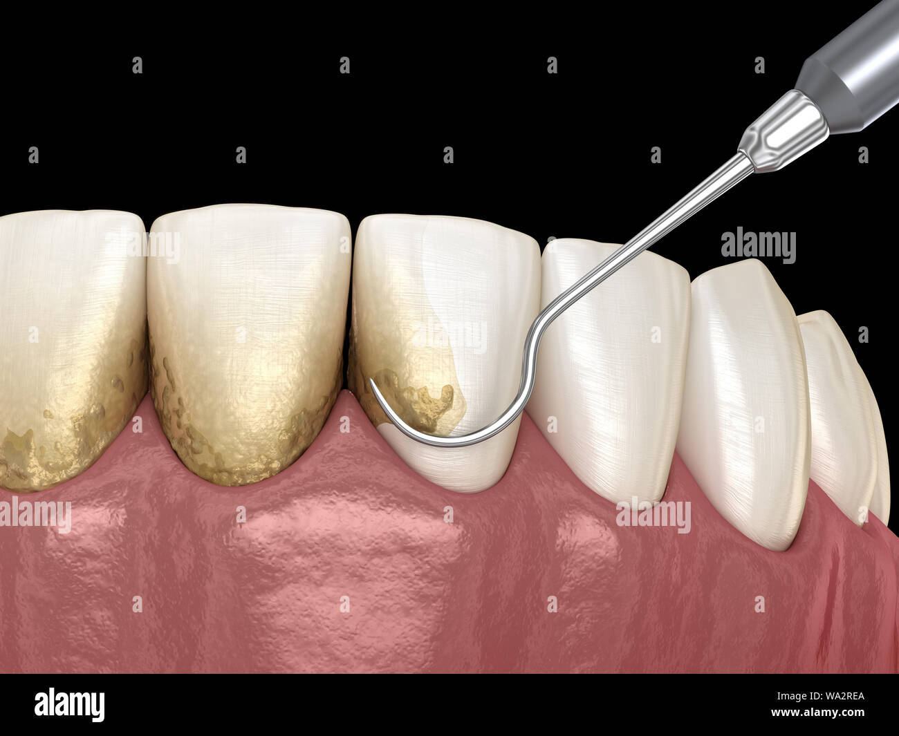 Oral hygiene Scaling and root planing (conventional periodontal