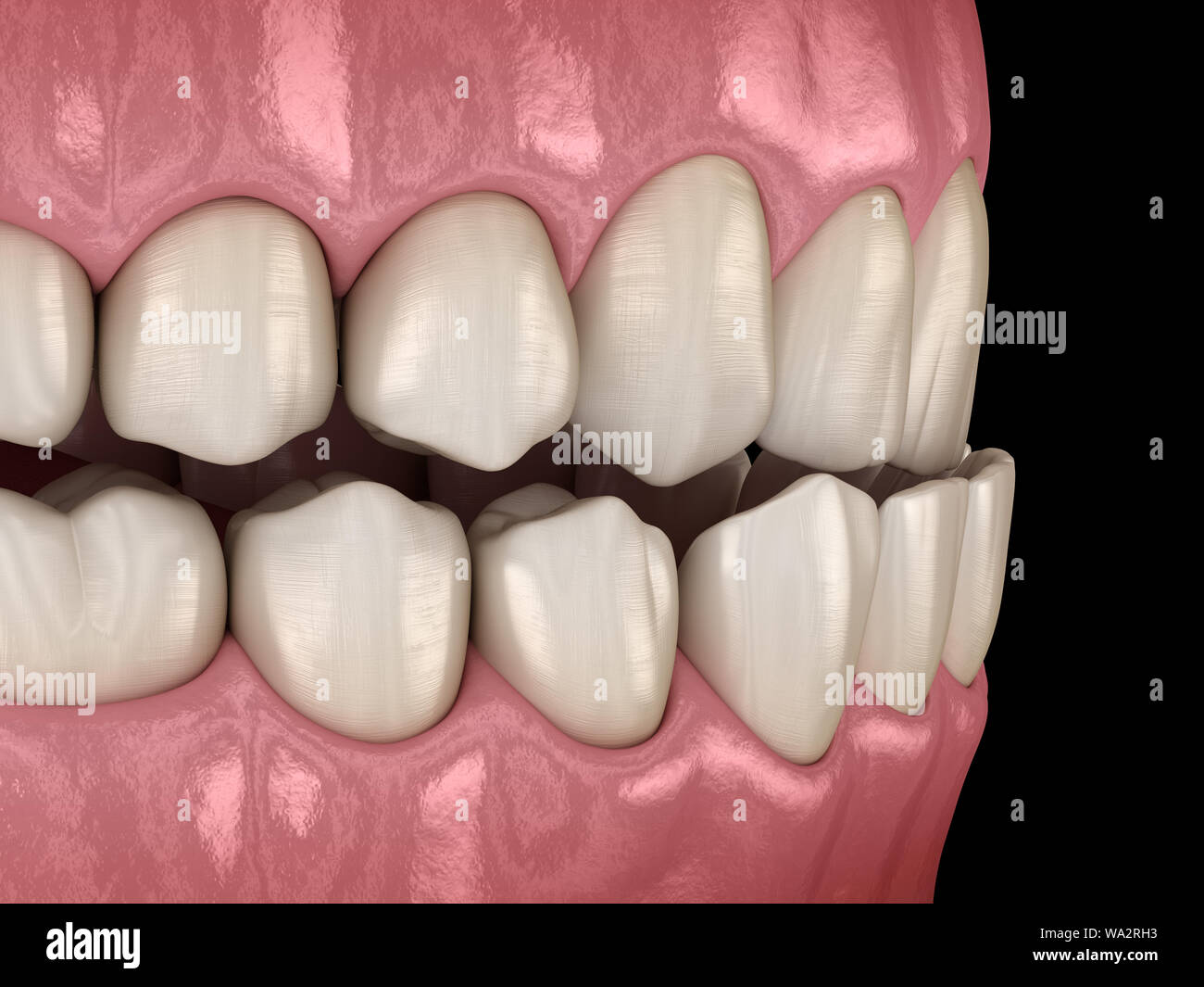 Underbite dental occlusion ( Malocclusion of teeth ). Medically ...