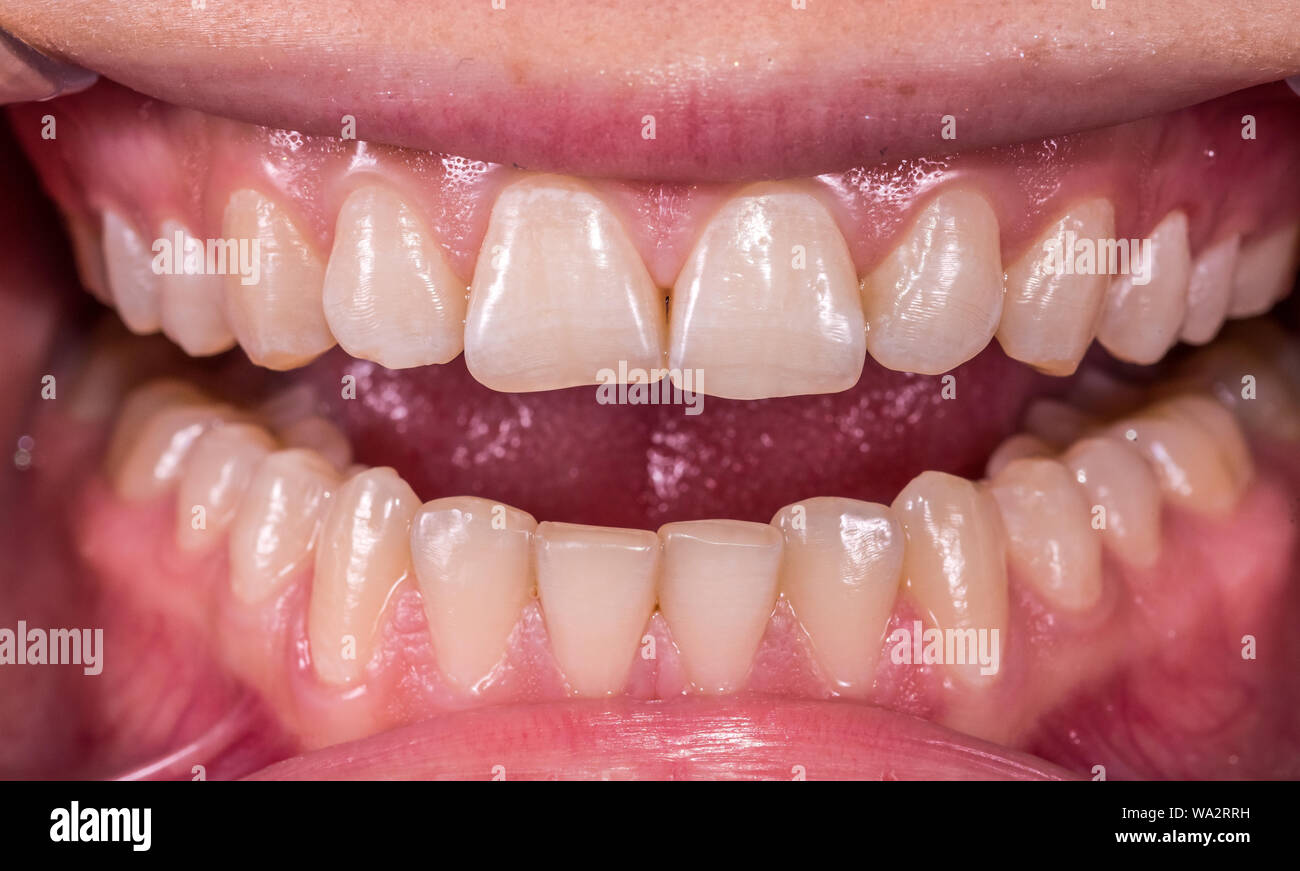 Healthy human teeth with normal occlusion from frontal intraoral view