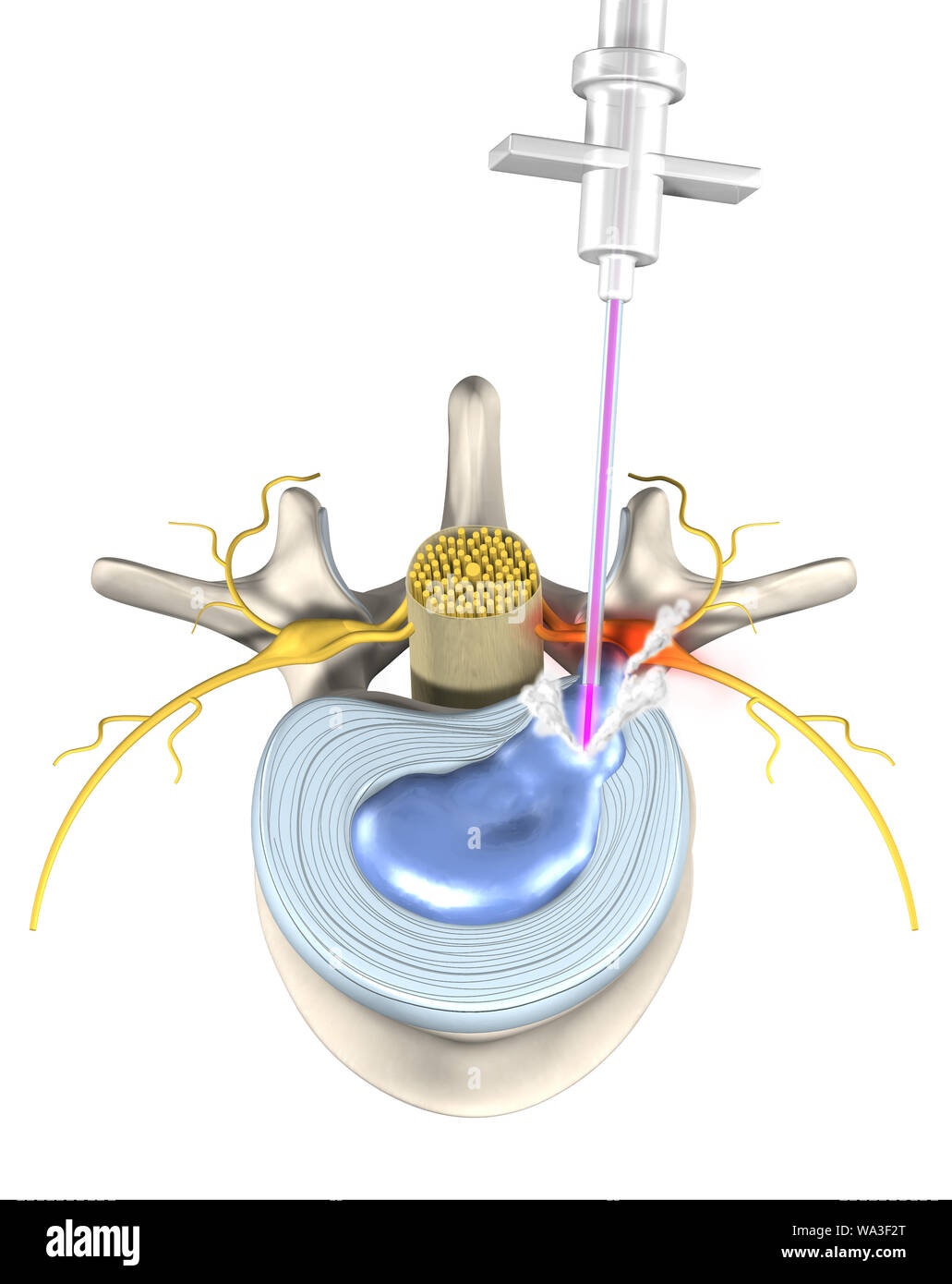 Painful herniated disk, minimally invasive therapy, medically 3D