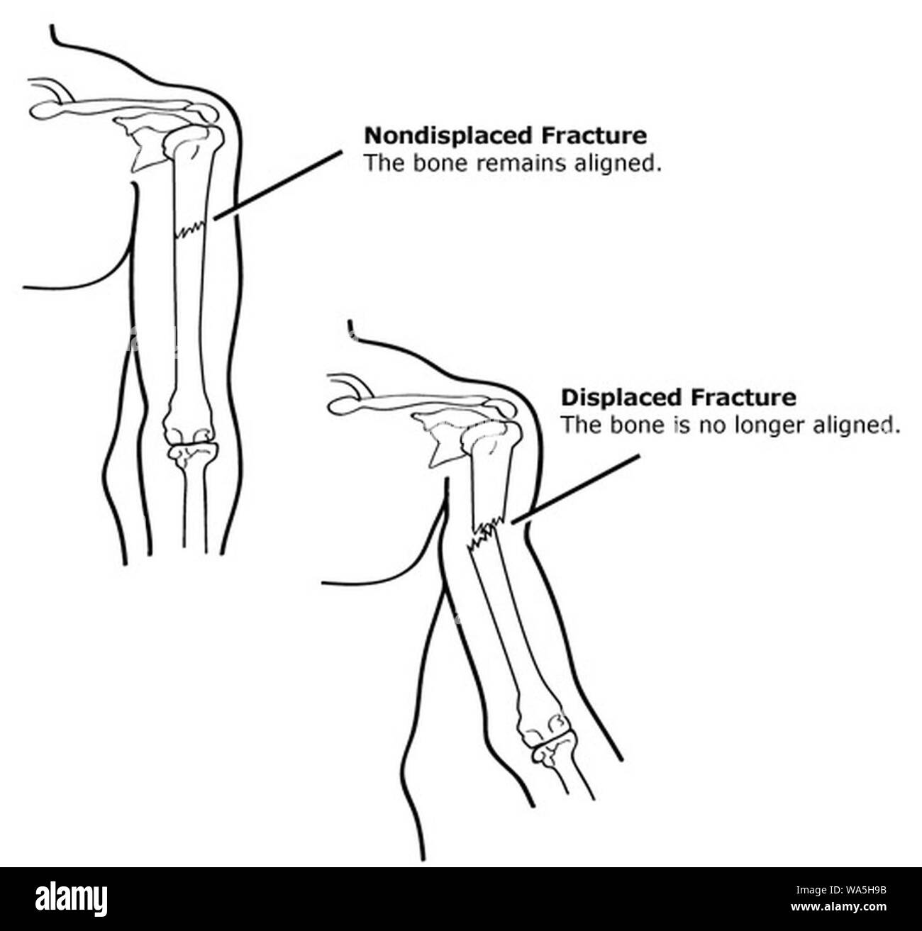The fracture can be. The fracture can be