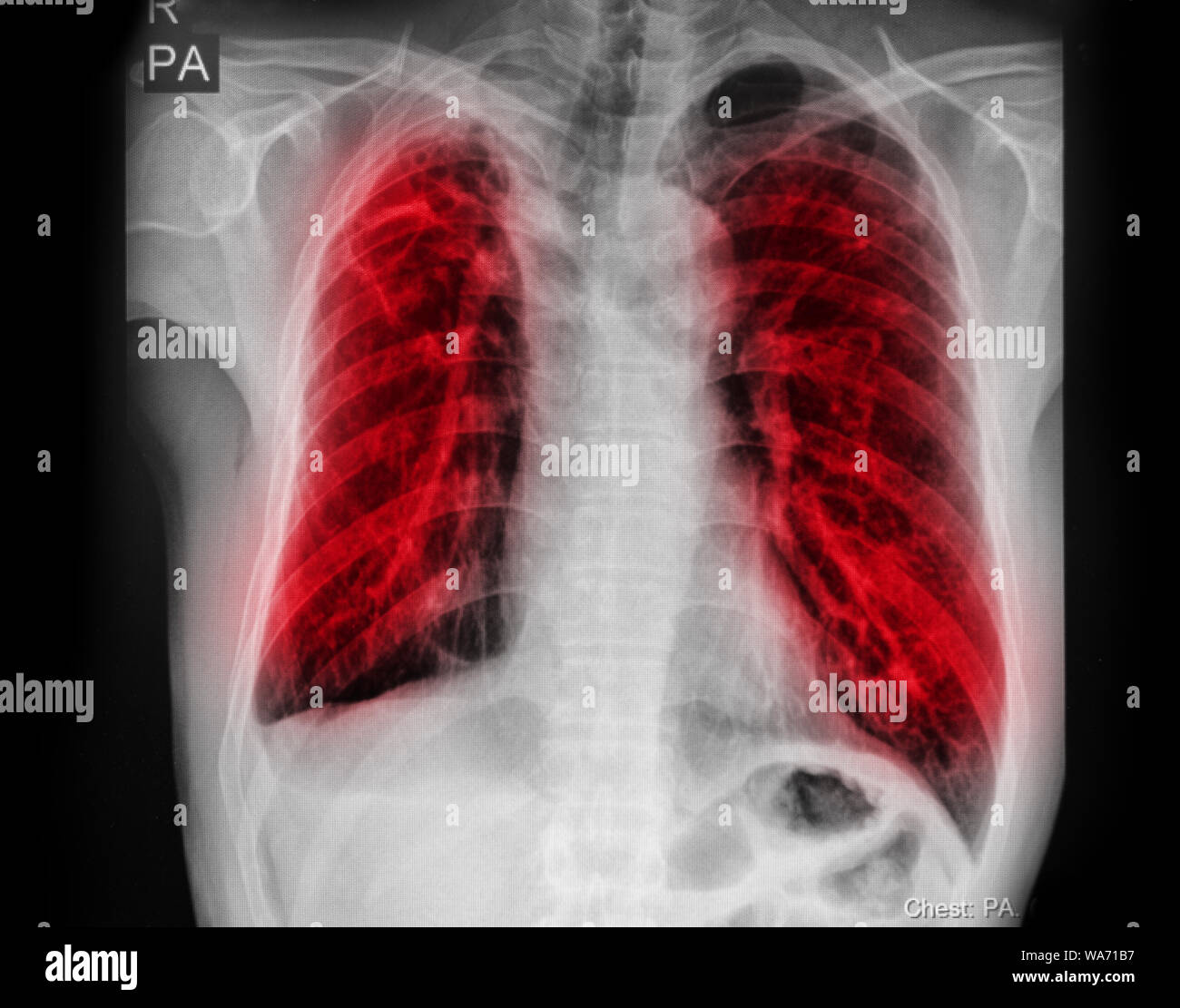 Pulmonary Tuberculosis ( TB ) : Chest x-ray show alveolar infiltration at both lung due to mycobacterium tuberculosis infection. Stock Photo