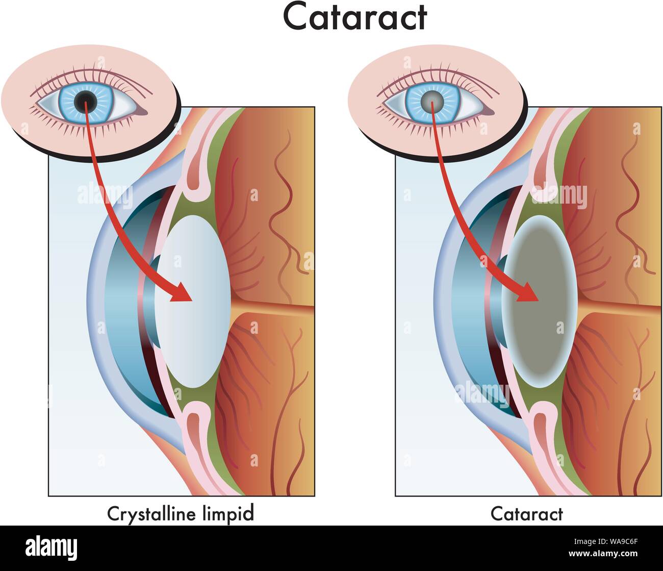 Medical illustration of the effects of cataract. Stock Vector