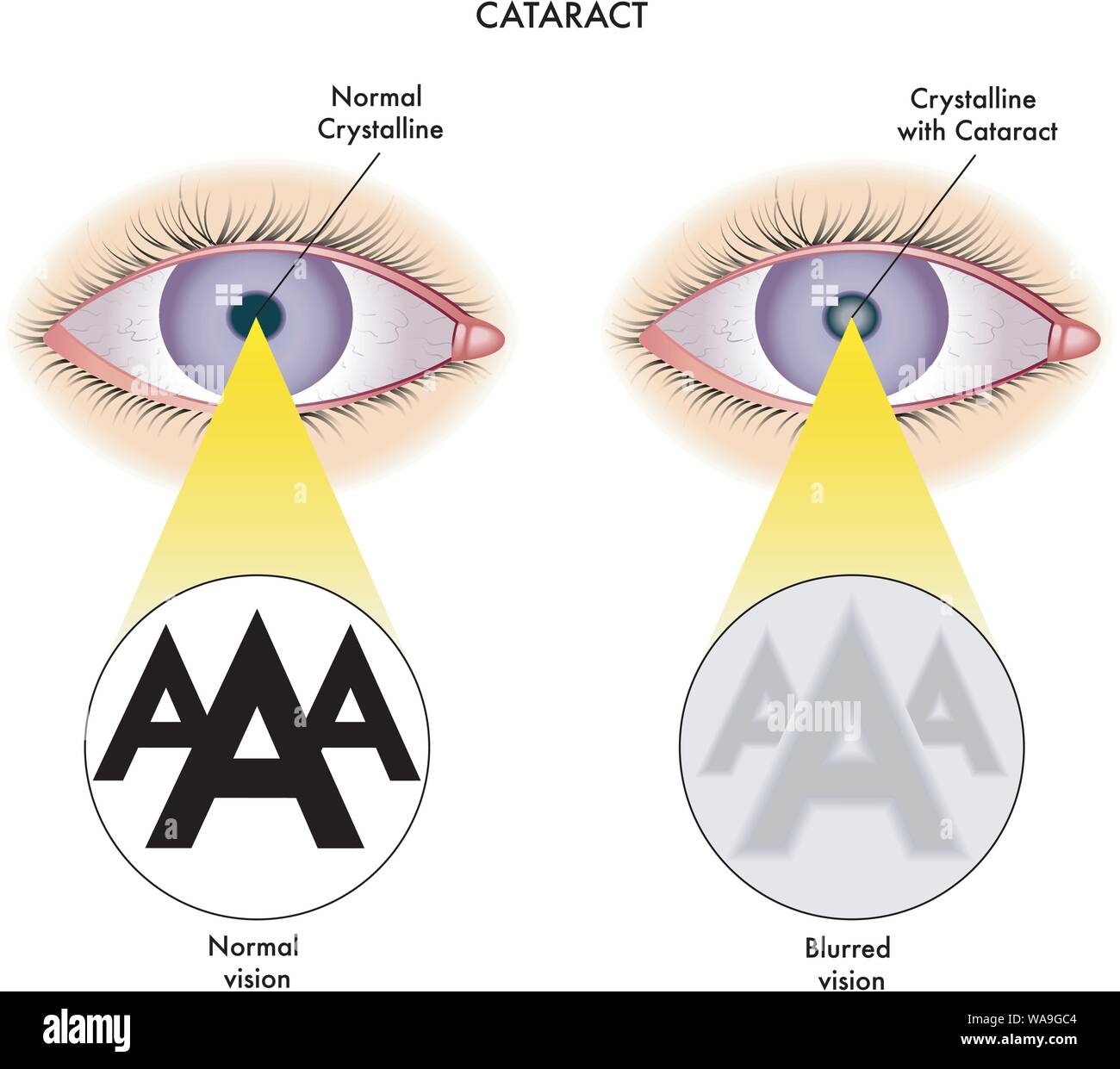 Medical illustration of the effects of cataract. Stock Vector