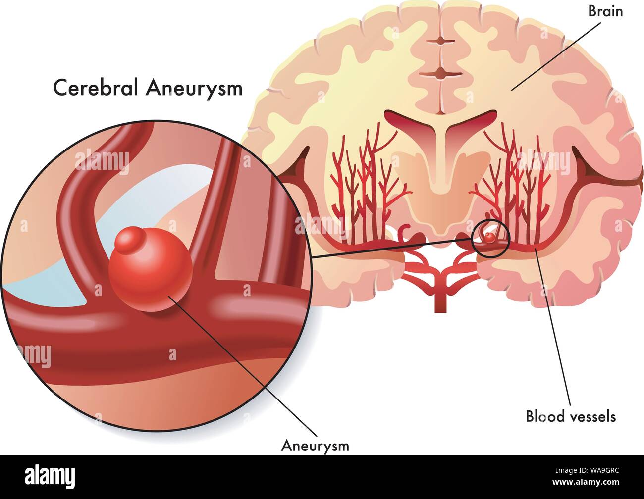 Medical illustration of the symptoms of cerebral aneurysm. Stock Vector