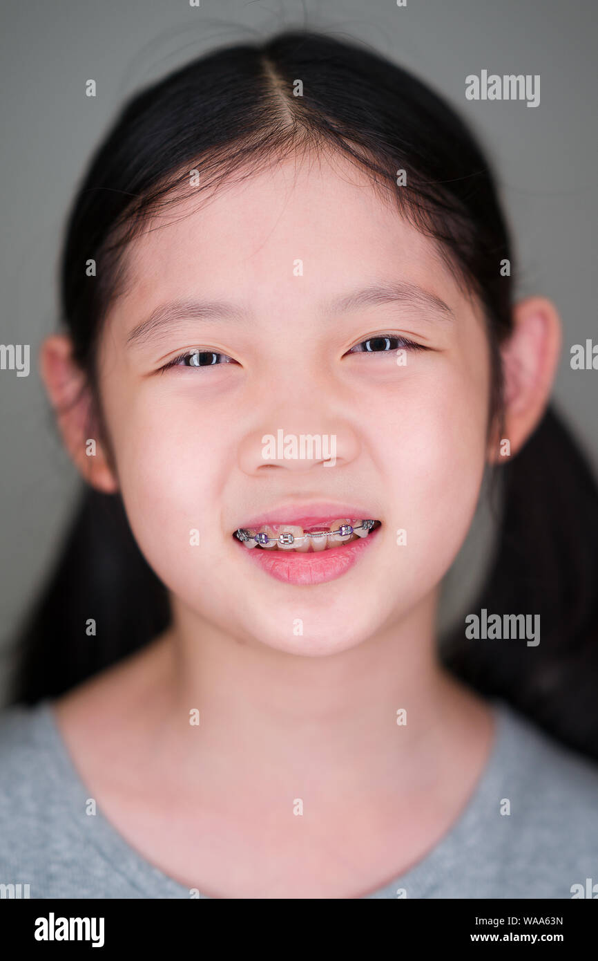 Smiling Asian Girl with Dental Braces Stock Photo Alamy