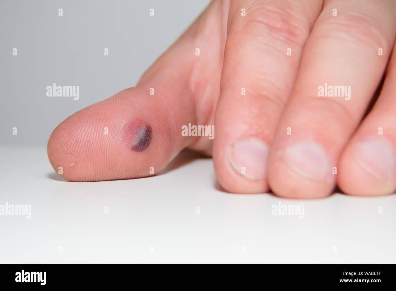 Blood blister under the thumb skin. Caucasian young man finger on white background Stock Photo