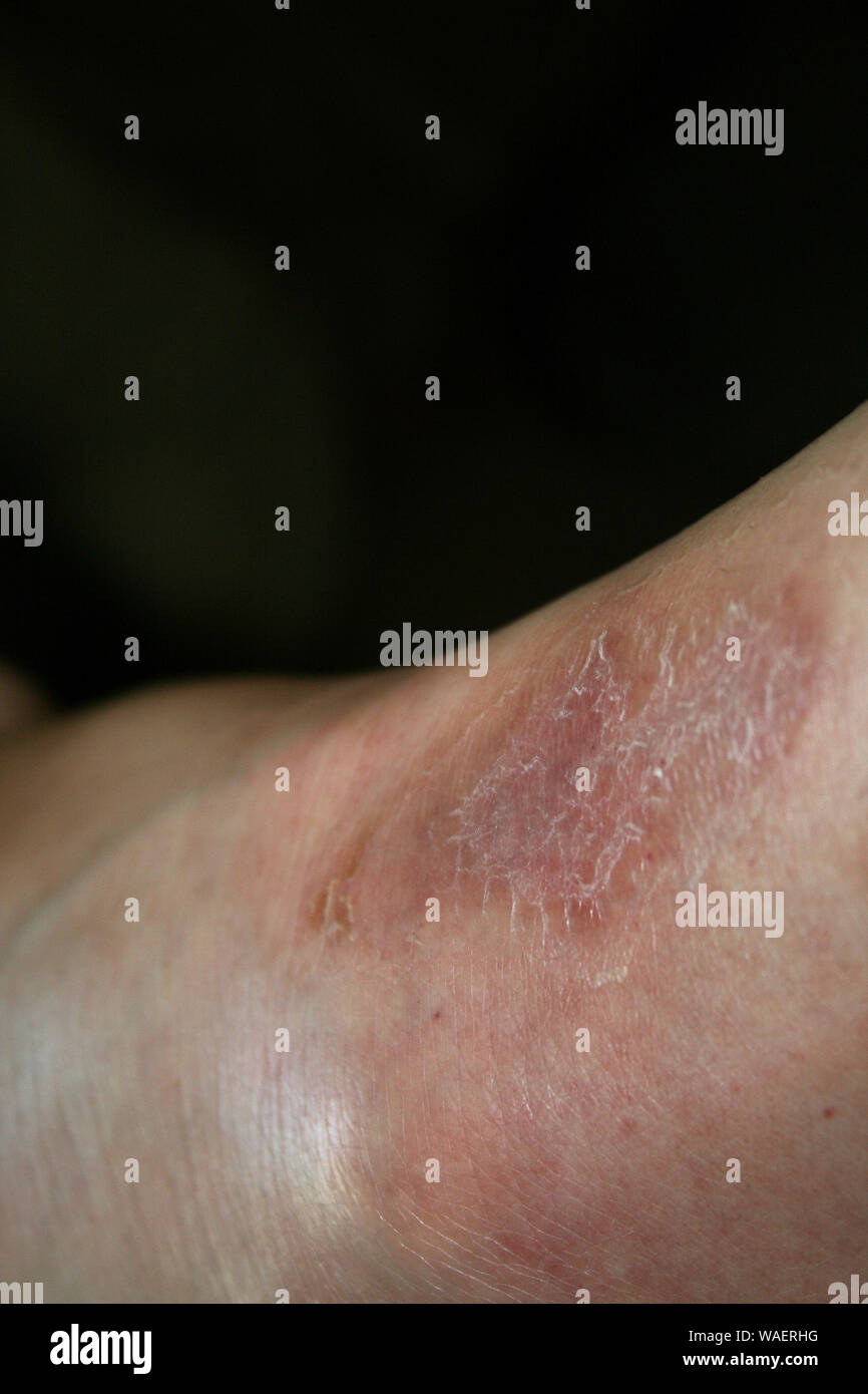 Burn scars hi-res stock photography and images - Alamy