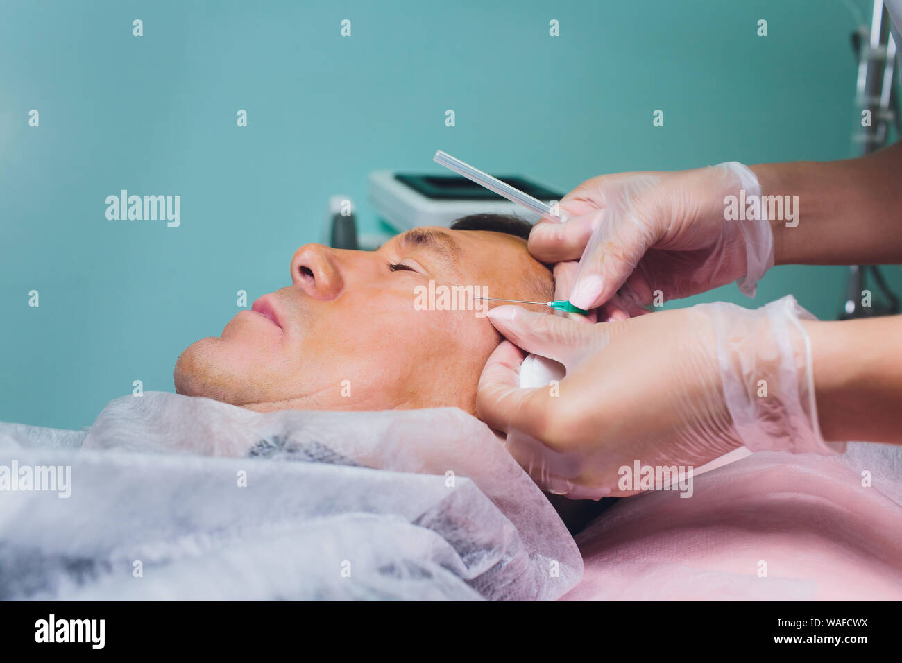 Closeup of procedure for face lifting PDO Suture operation, face