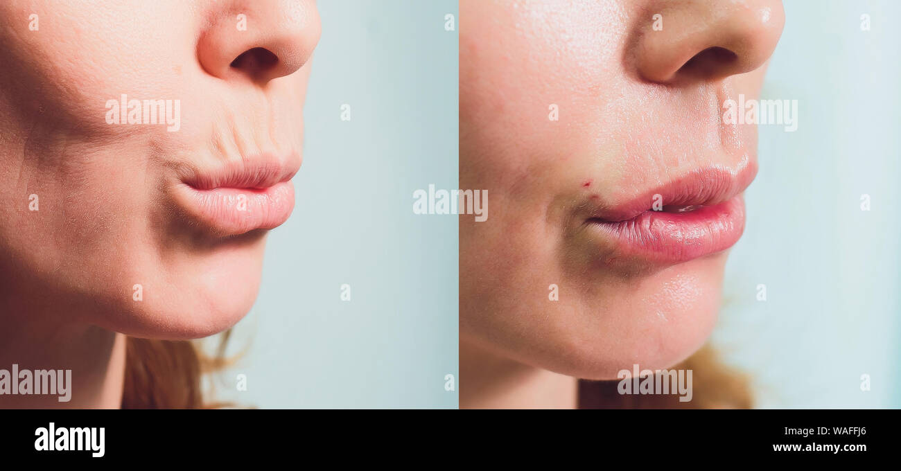 threading upper lip before and after
