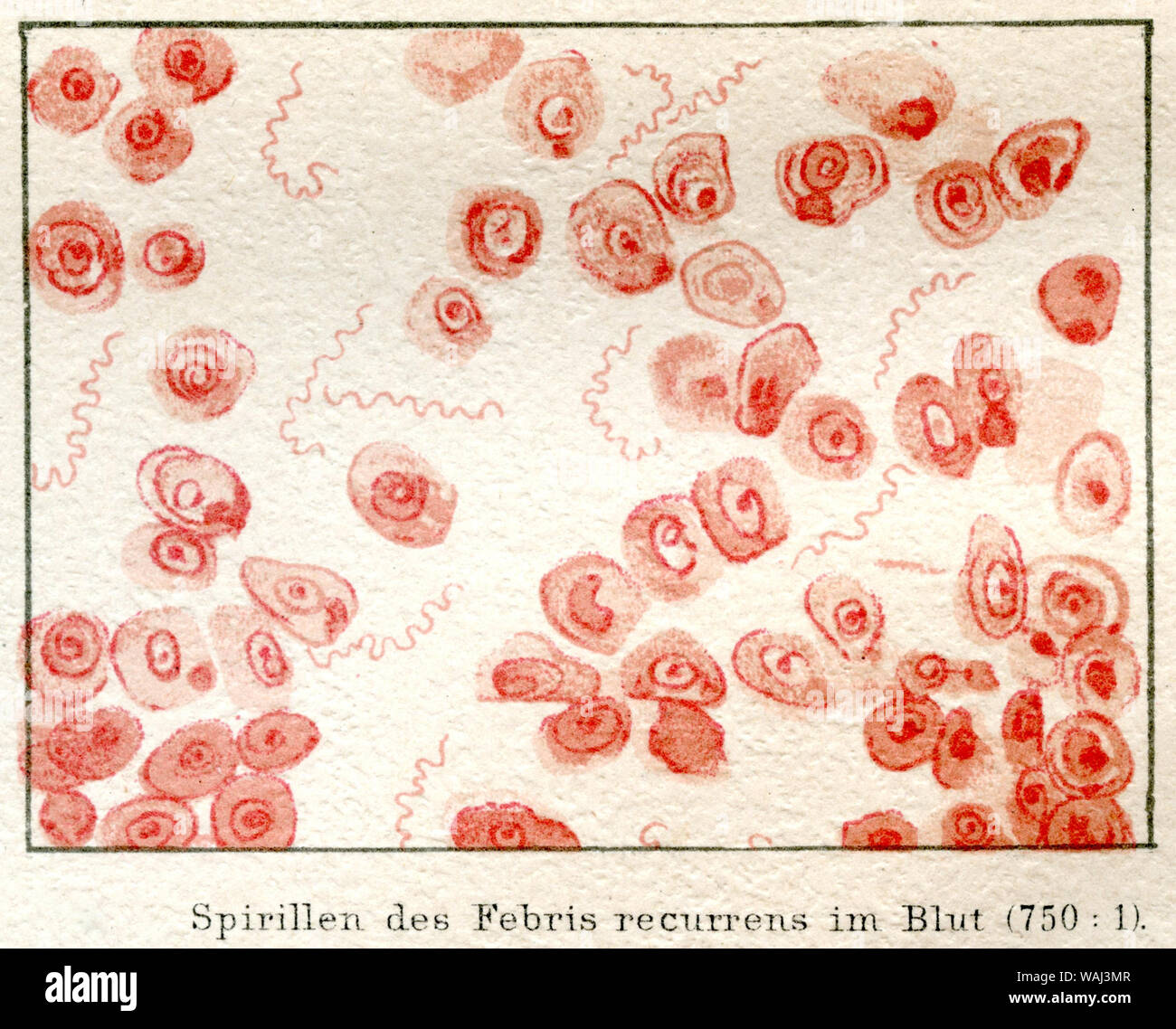 Spirils of Febris recurrens (relapsing fever) in the blood of a patient under the microscope (750 : 1). ,  (encyclopedia, 1885) Stock Photo