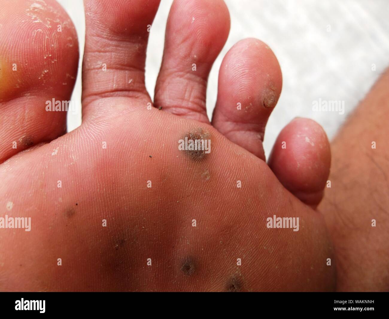 Feet disease hi res stock photography and images Alamy