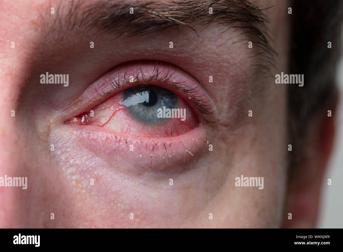 Close up of a severe bloodshot eye. Blepharitis, Conjunctivitis