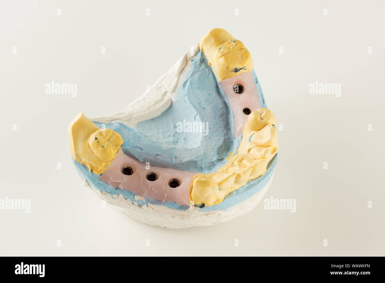 dental plaster model with artificial analogues of dental implants Stock