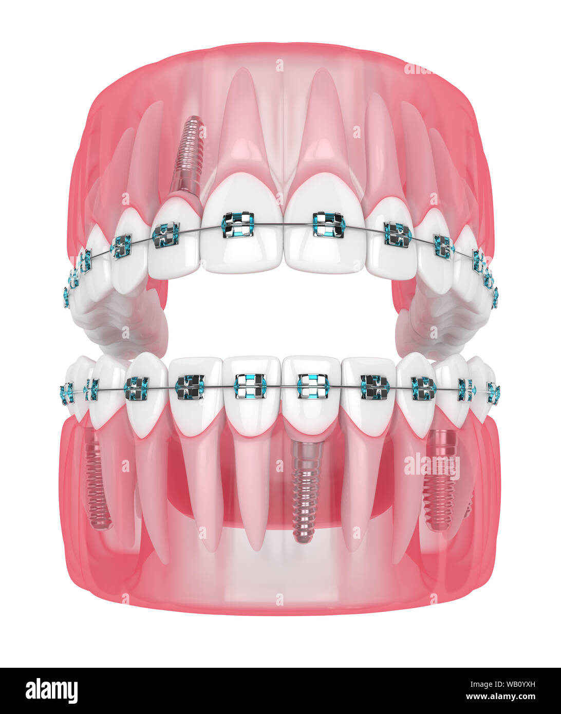 3d render of jaw with implants and orthodontic braces isolated over ...