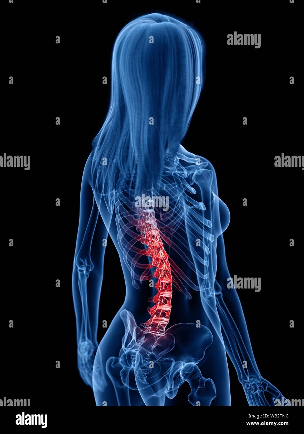 Back pain, conceptual illustration Stock Photo - Alamy