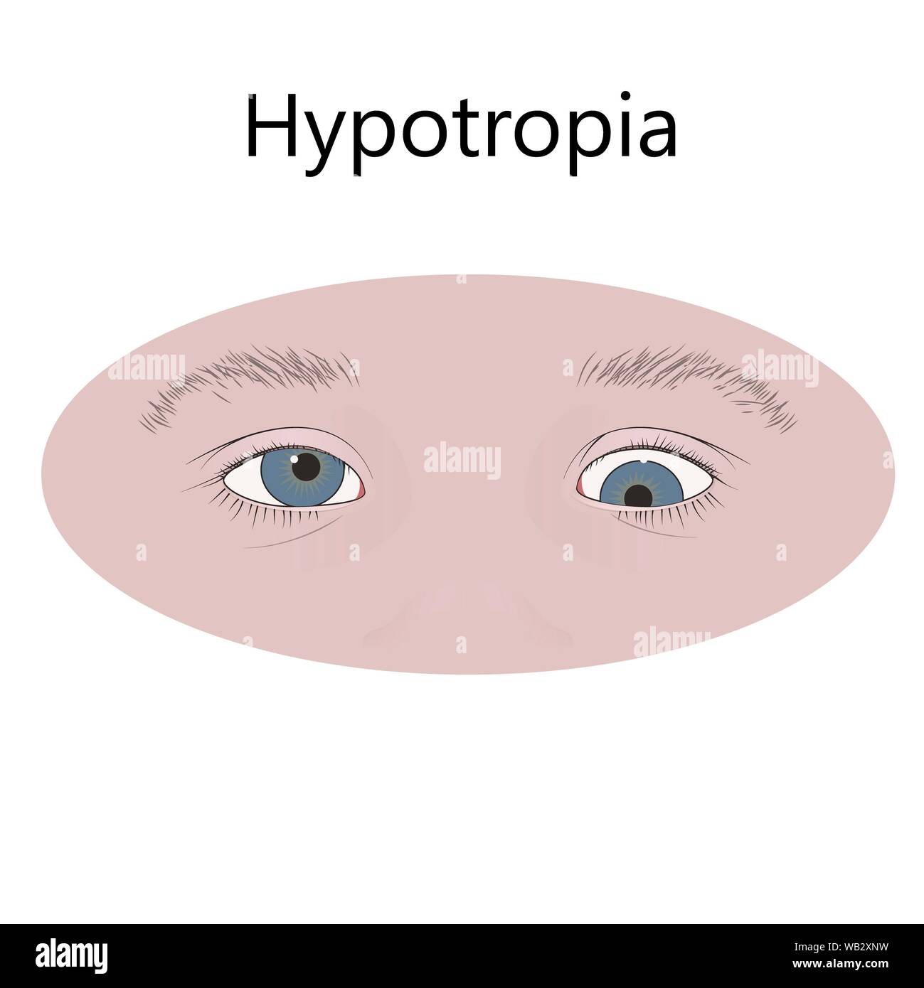 Childhood hypotropia, illustration. Stock Photo