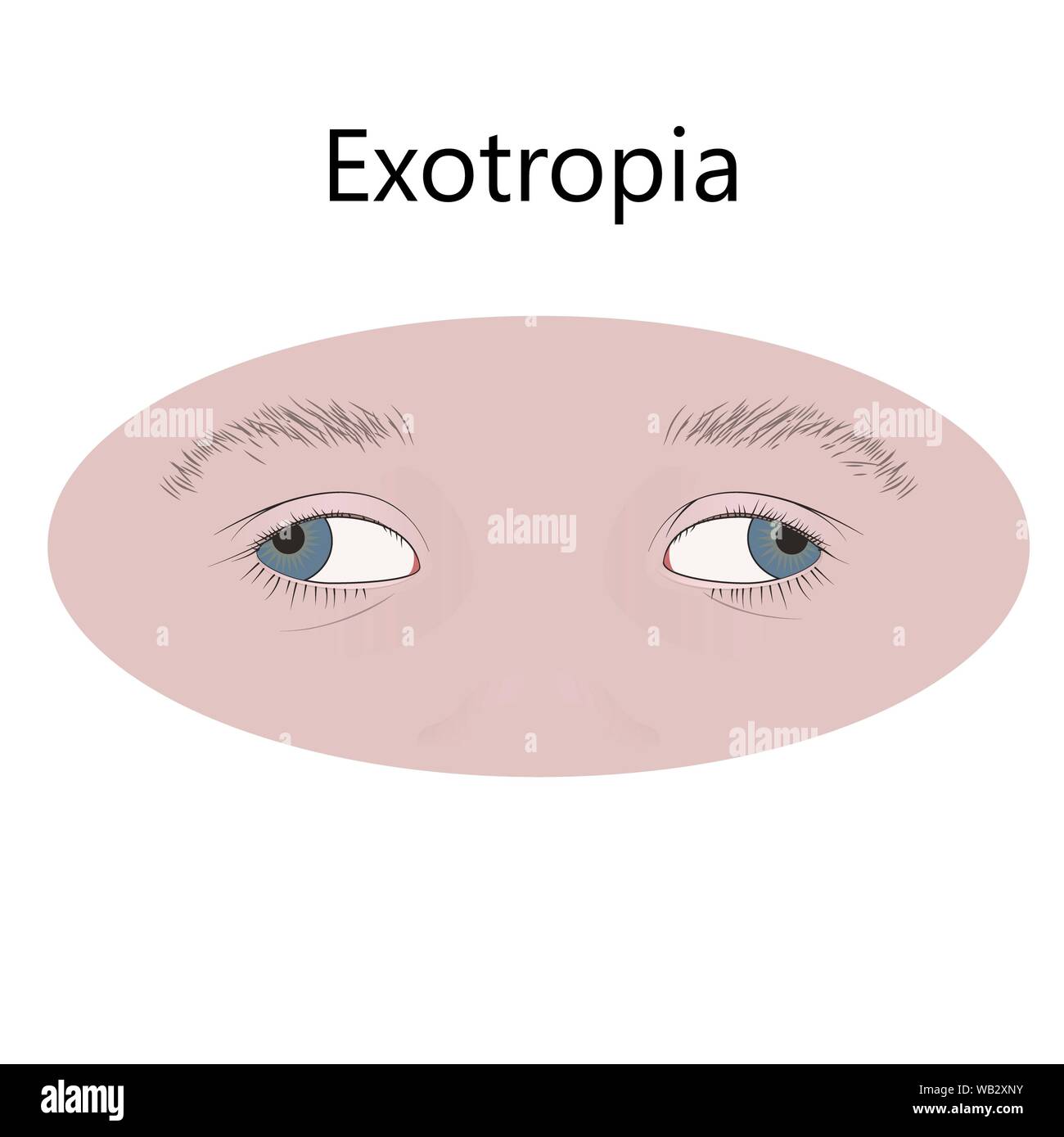 Childhood exotropia, illustration. Stock Photo