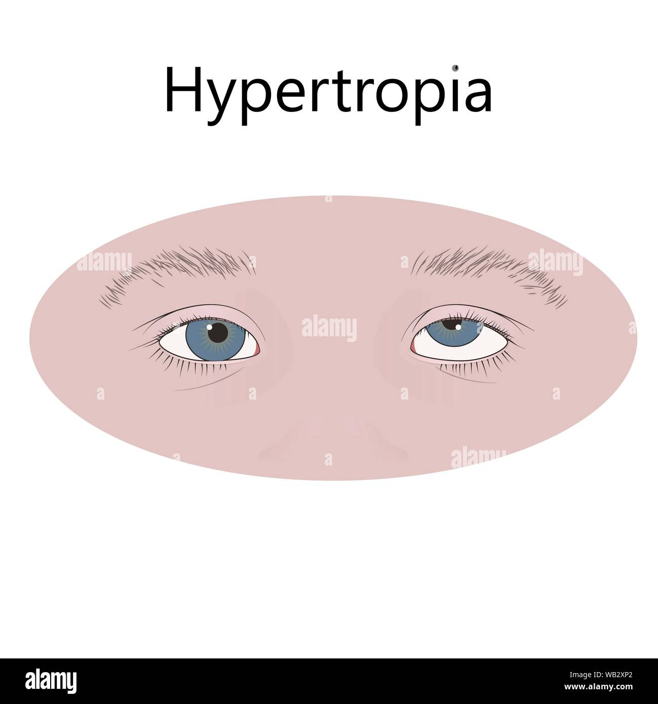 Childhood hypertropia, illustration. Stock Photo