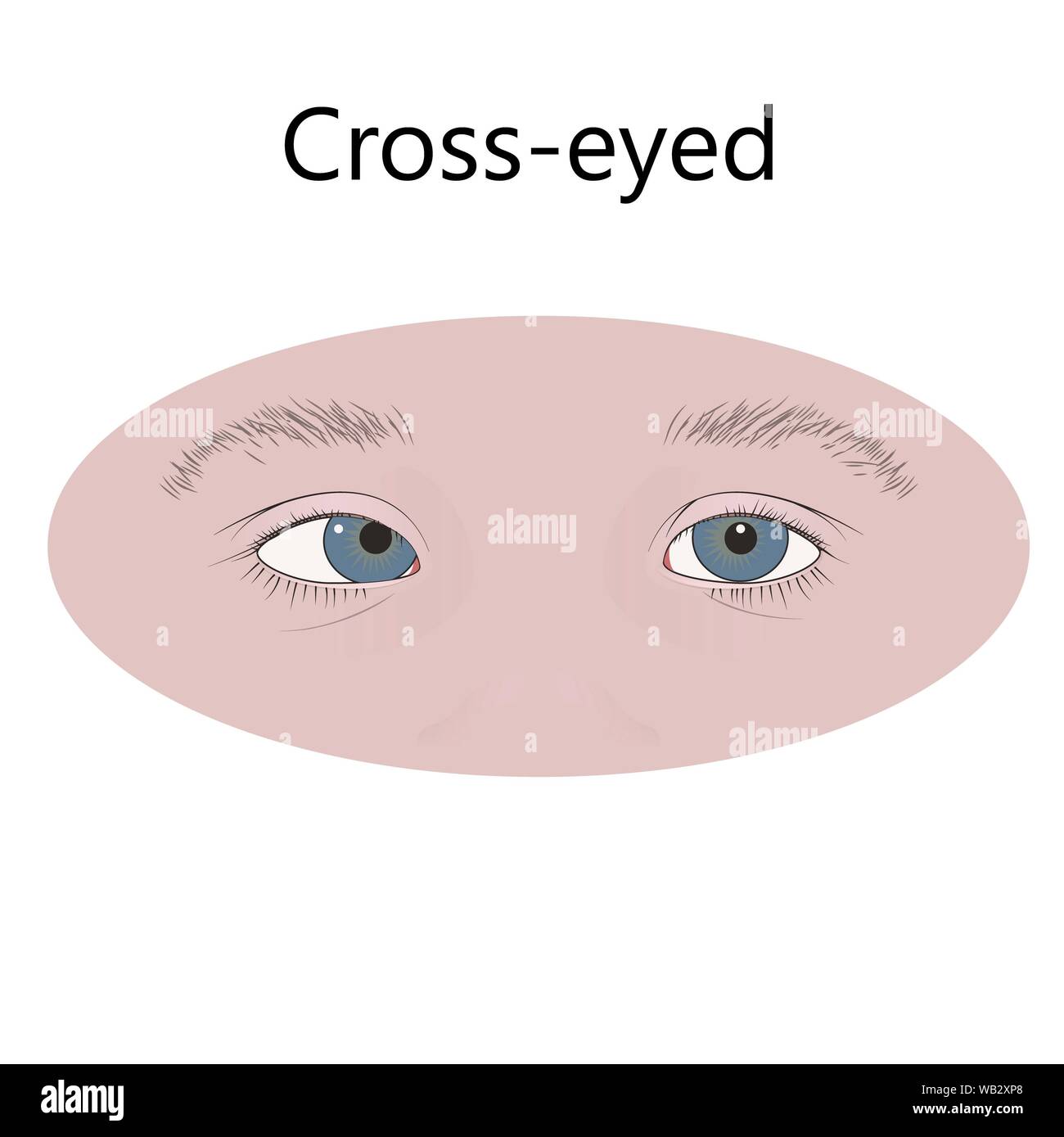 Cross-eyed child, illustration. Strabismus, esotropia, inward eyes. Stock Photo