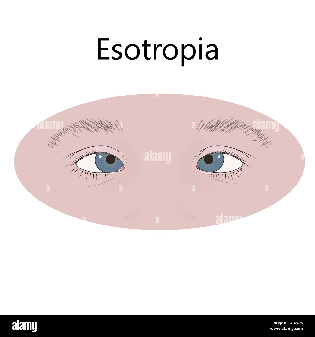 Cross-eyed child, illustration. Childhood esotropia. Stock Photo