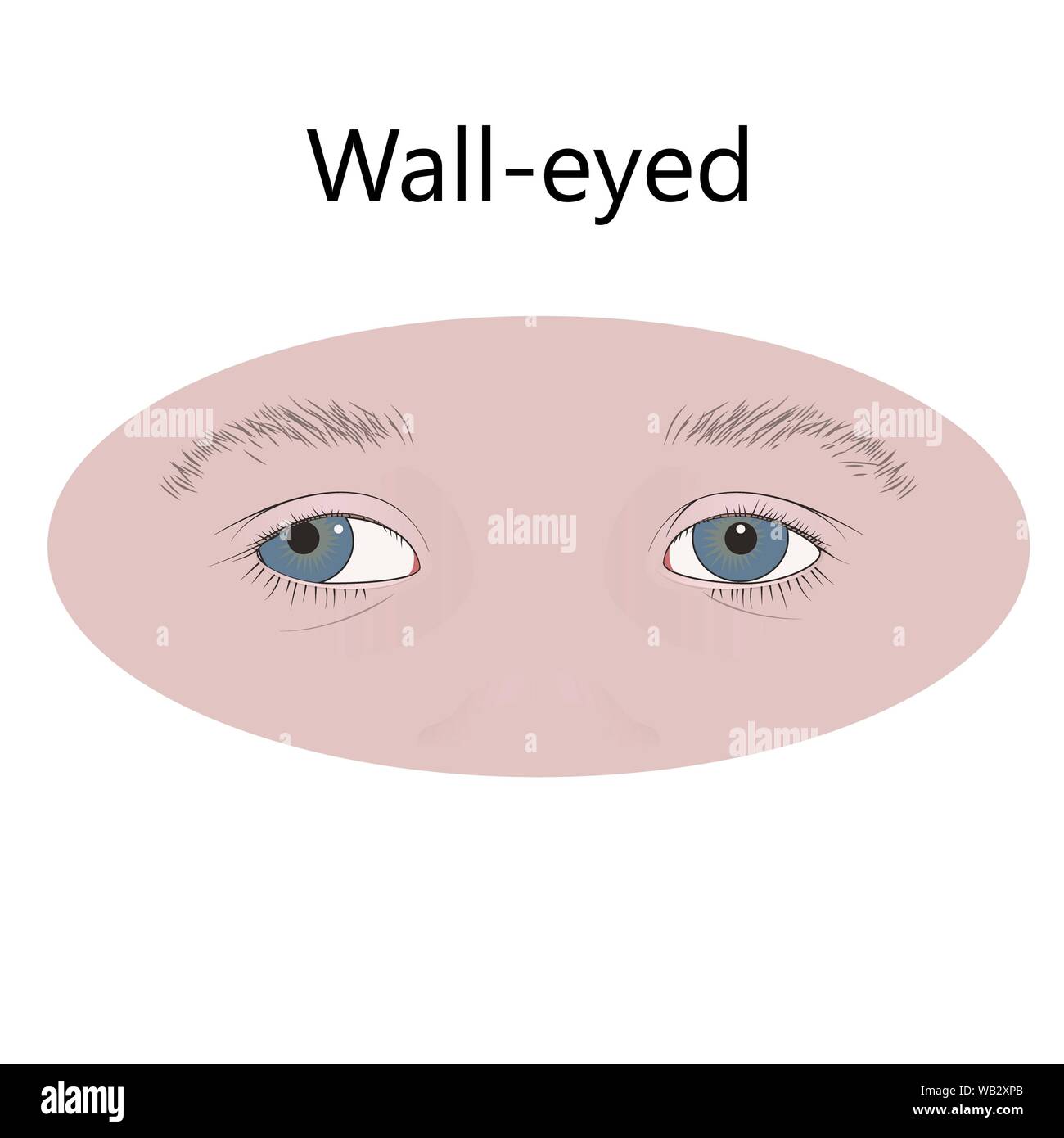 Walleyed child, illustration Stock Photo Alamy