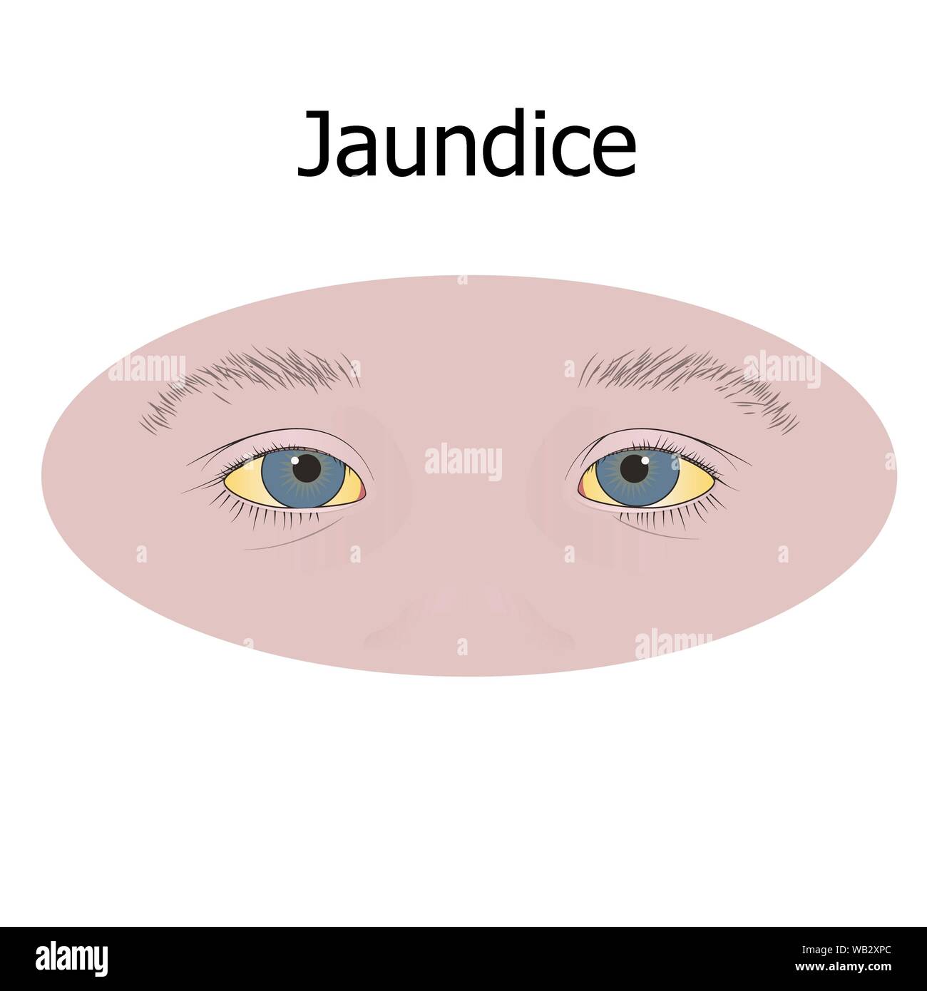 jaundiced eyes in adults
