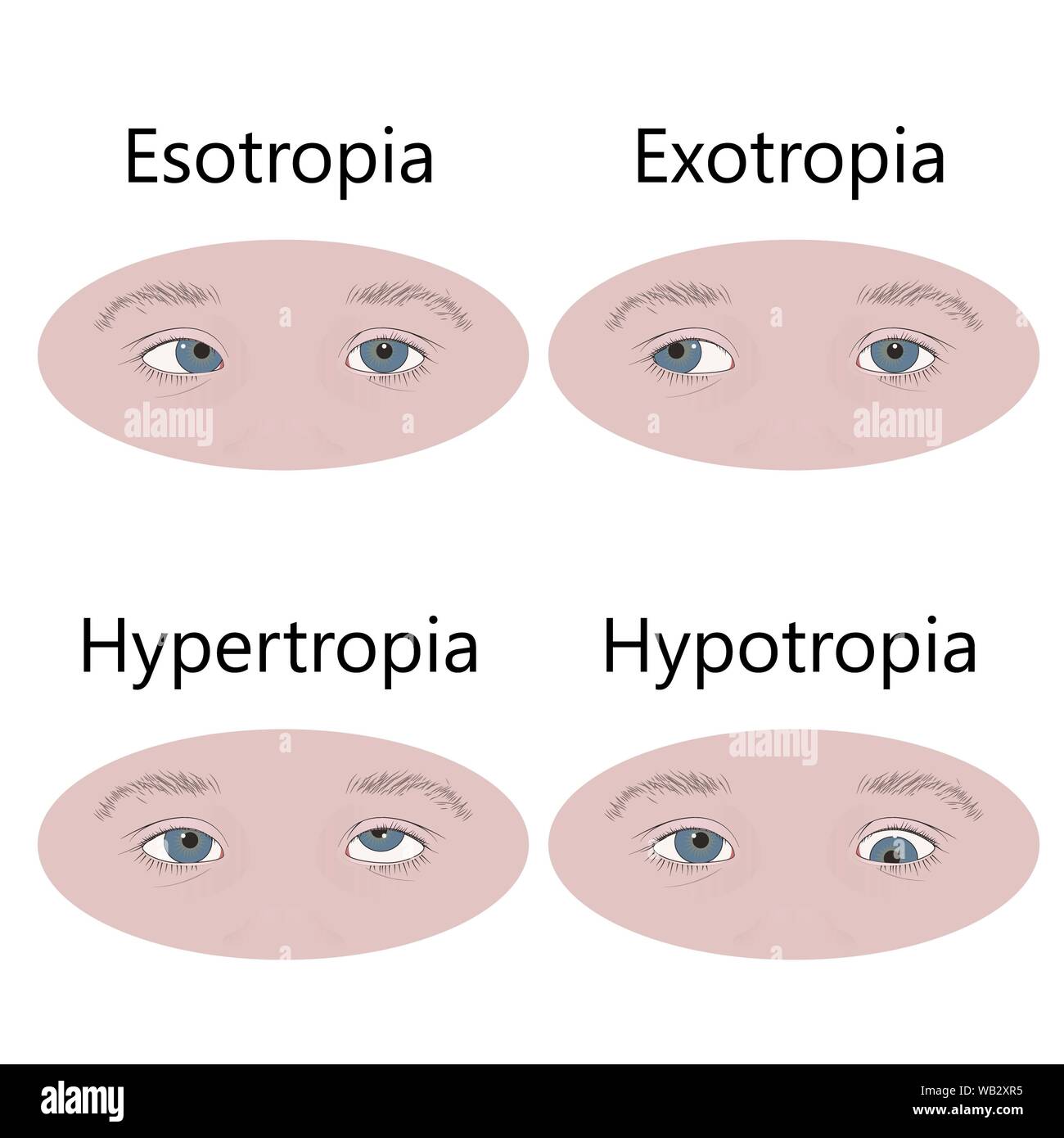 Childhood strabismus types, illustration. Stock Photo