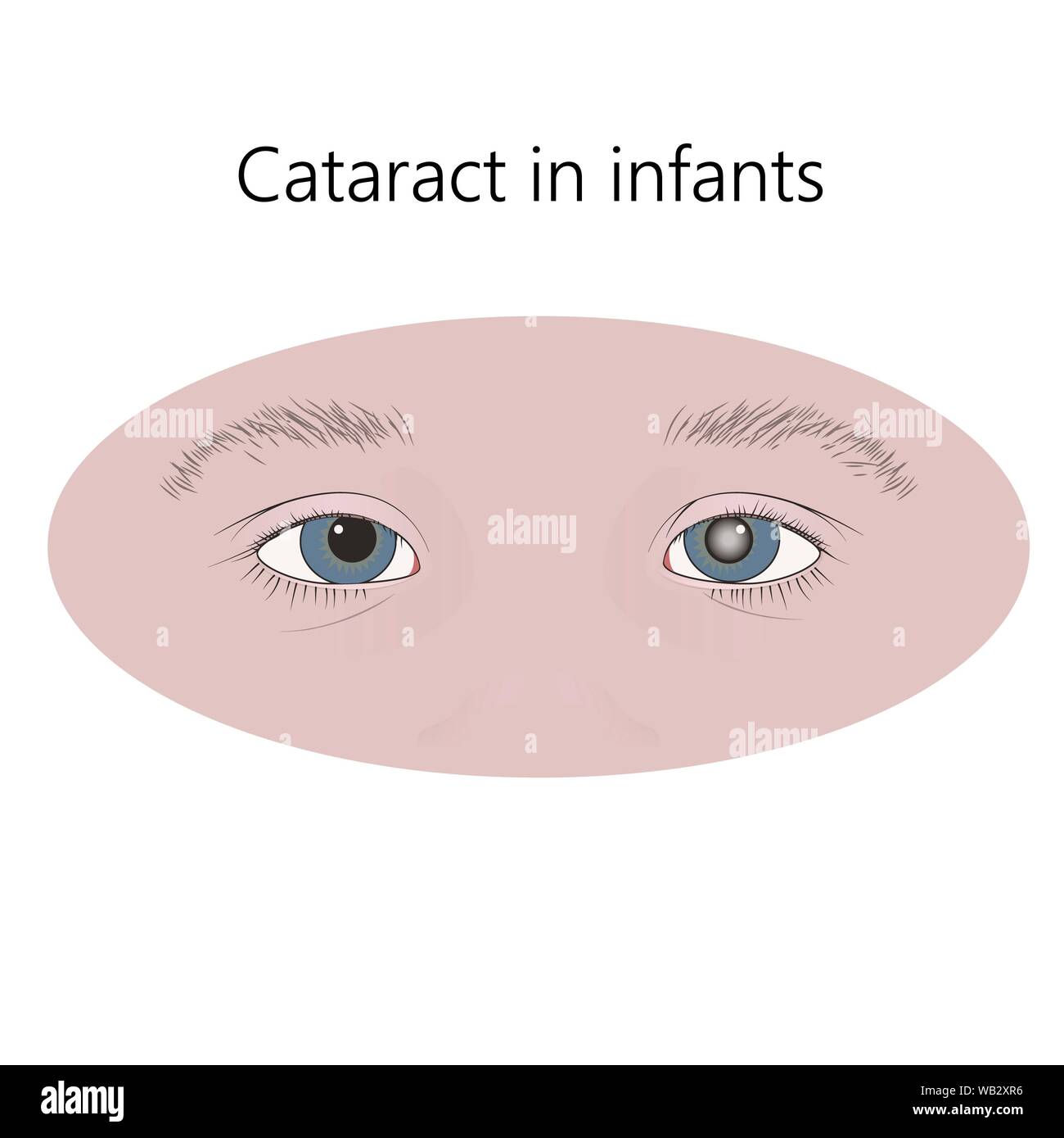 Childhood cataract, illustration. Stock Photo