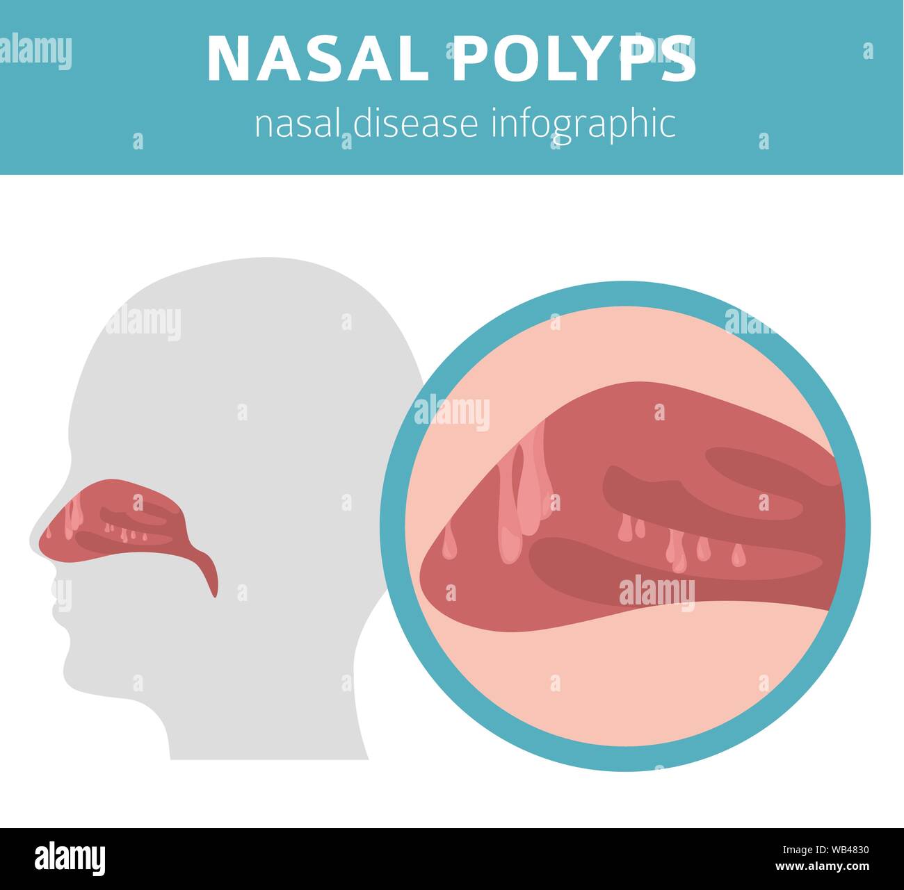 Nasal diseases. Nasal polyps causes, diagnosis and treatment medical
