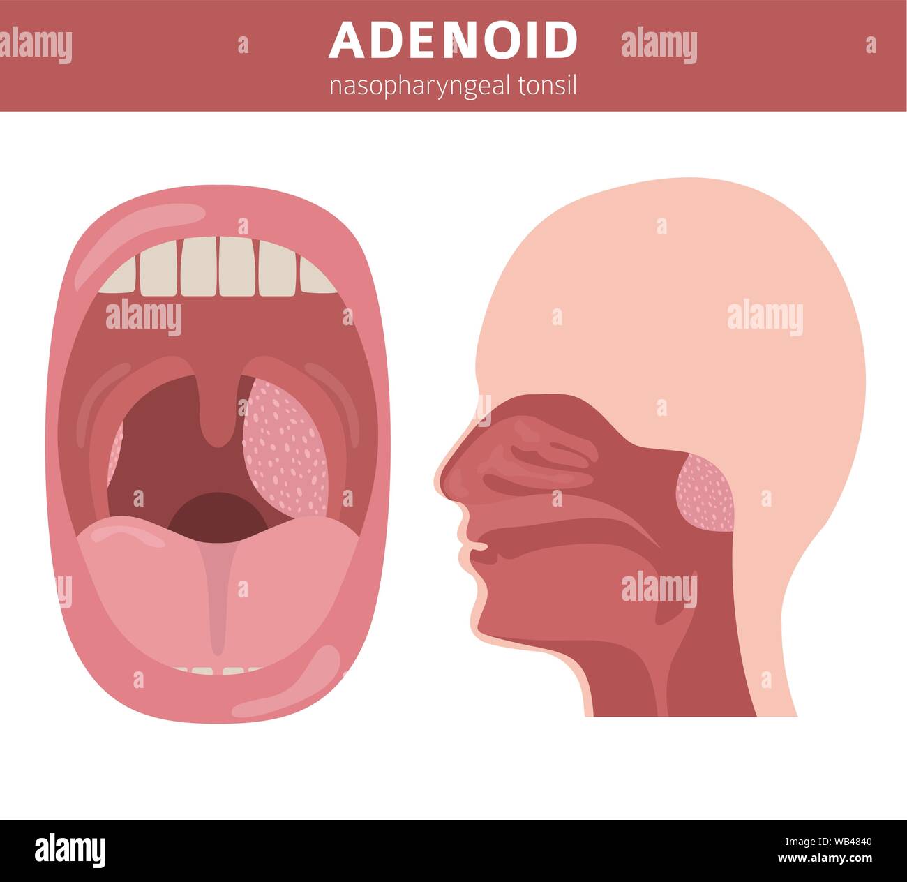 Nasal and throat, nasopharynx diseases. Adenoids diagnosis and treatment medical infographic design. Vector illustration Stock Vector