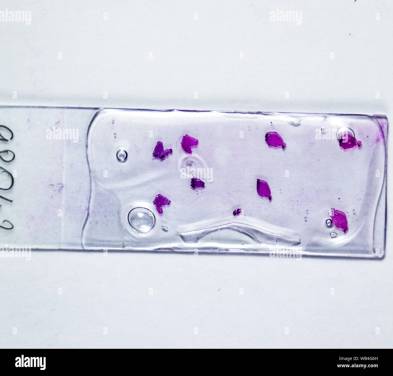 Slices of the tumor under glass. Histological examination of tumor cells for the presence of cancer. Samples of tumor cells under the sleek against th Stock Photo