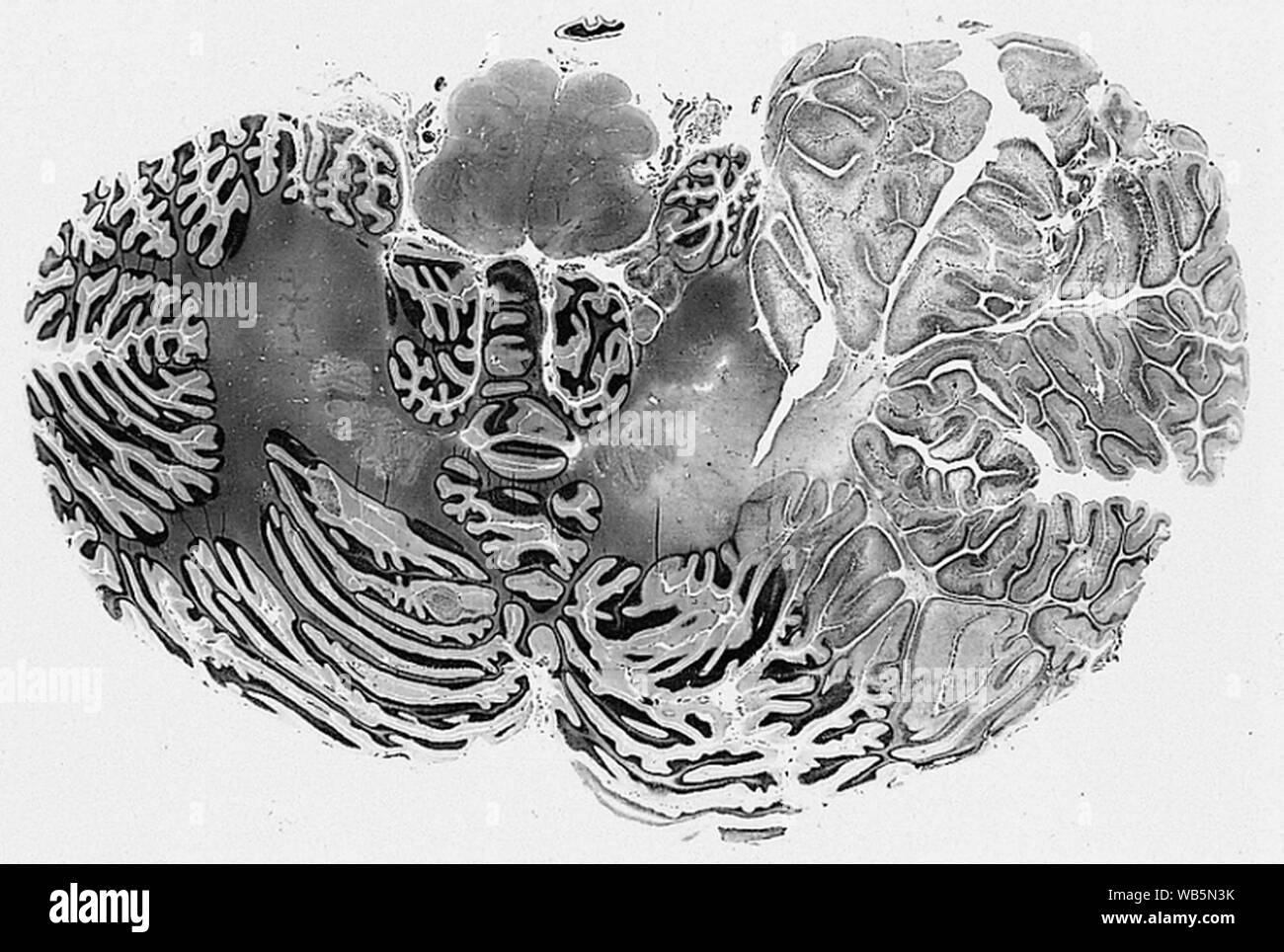 Dysplastic cerebellar gangliocytoma. Stock Photo