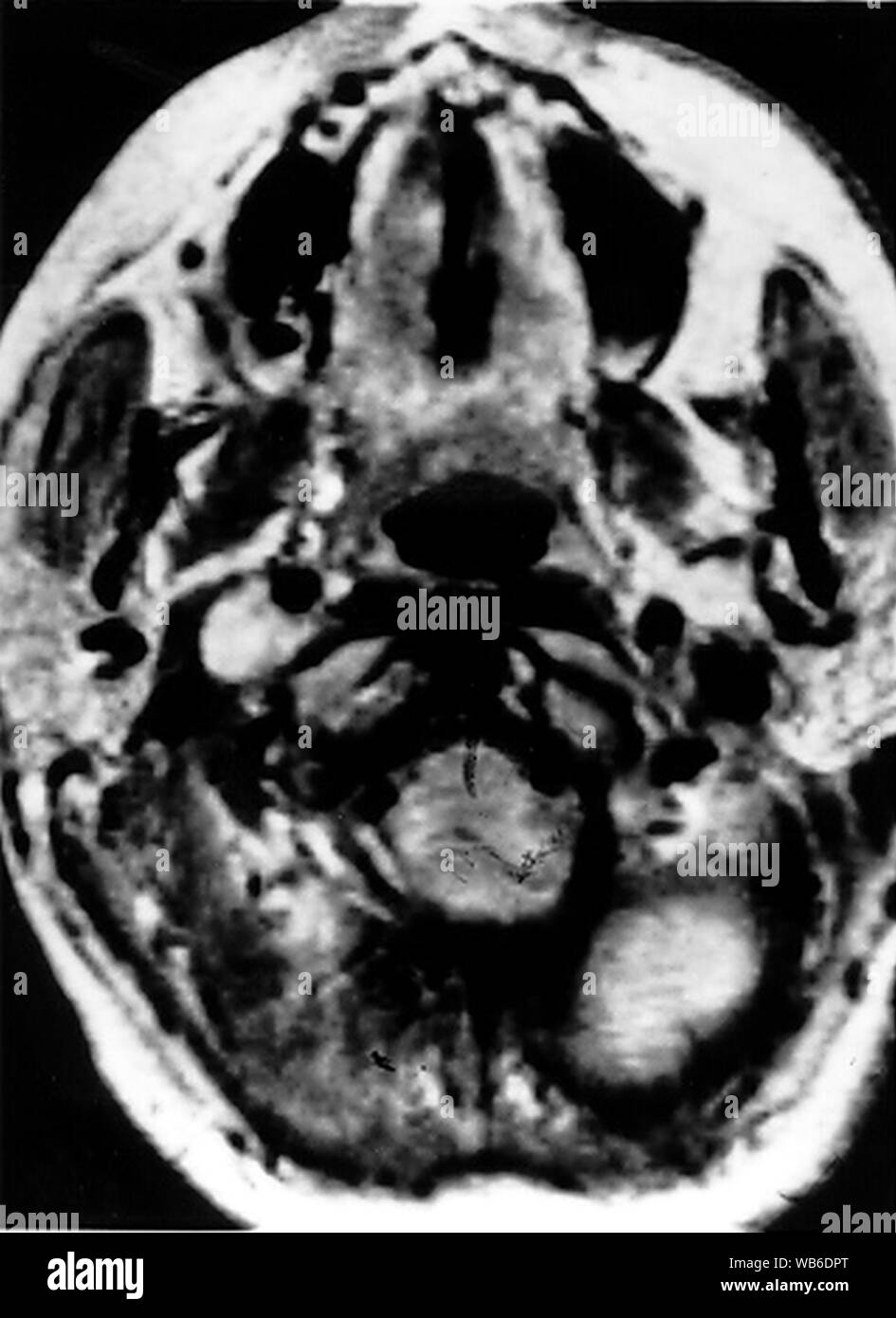 Ectopic functional paraganglioma (glomus jugulare) in a patient with VHL. Stock Photo