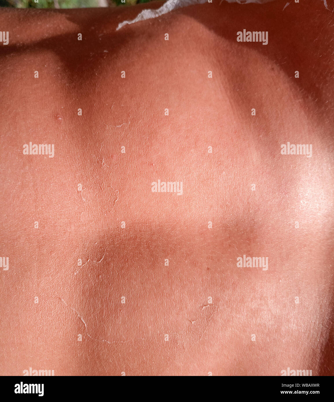 The effects of sunburn on the skin. Climb skin. Stock Photo