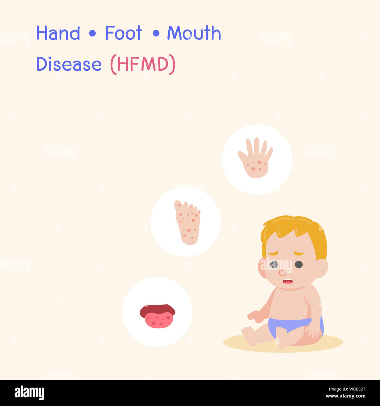 Children infected, Boy have a Blister Hand Foot Mouth Disease, HFMD in