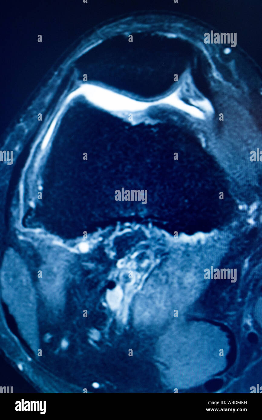 Knee sports injury mri mcl grade 2 tear resonance imaging
