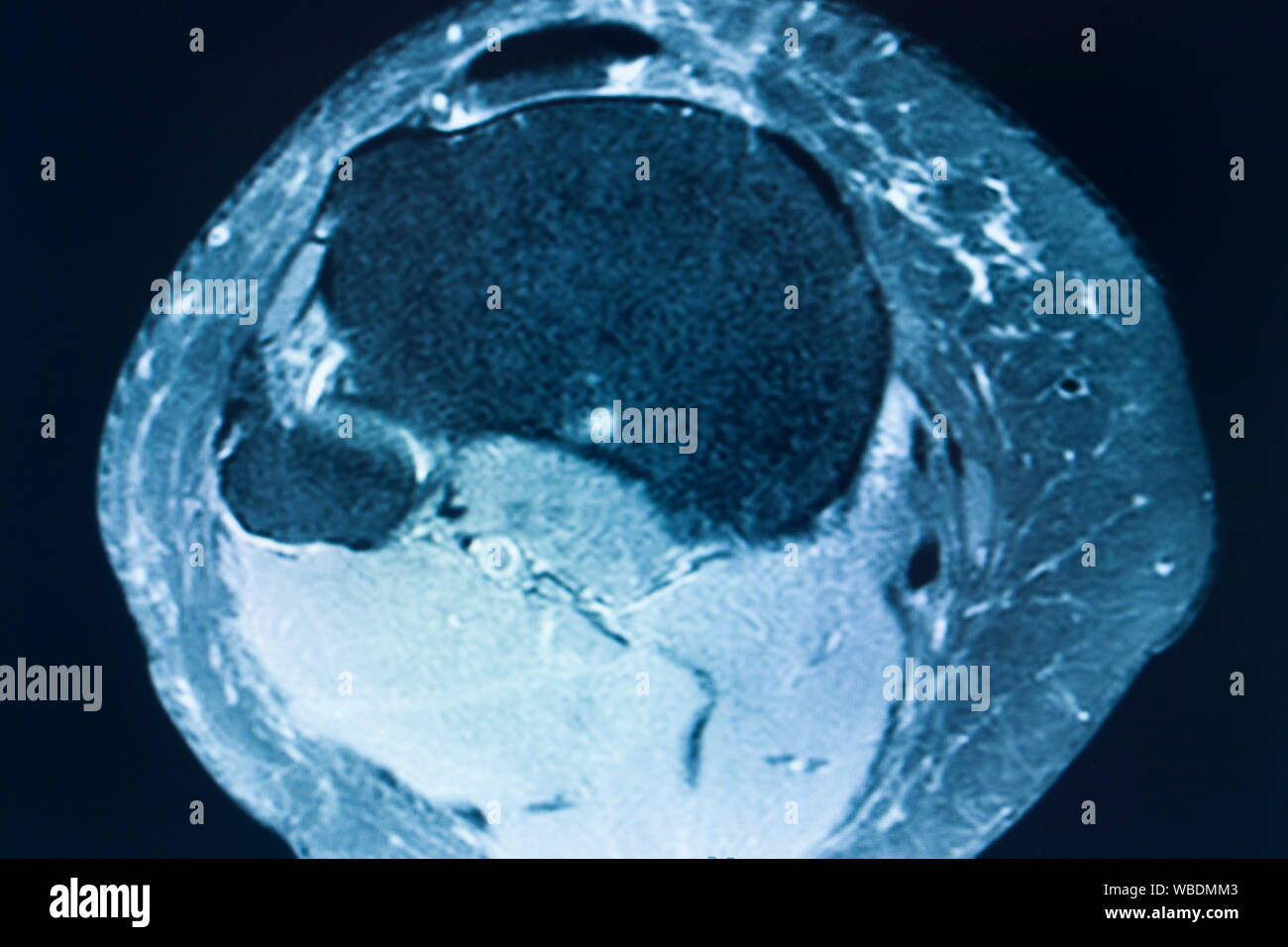 Knee sports injury mri mcl grade 2 tear resonance imaging