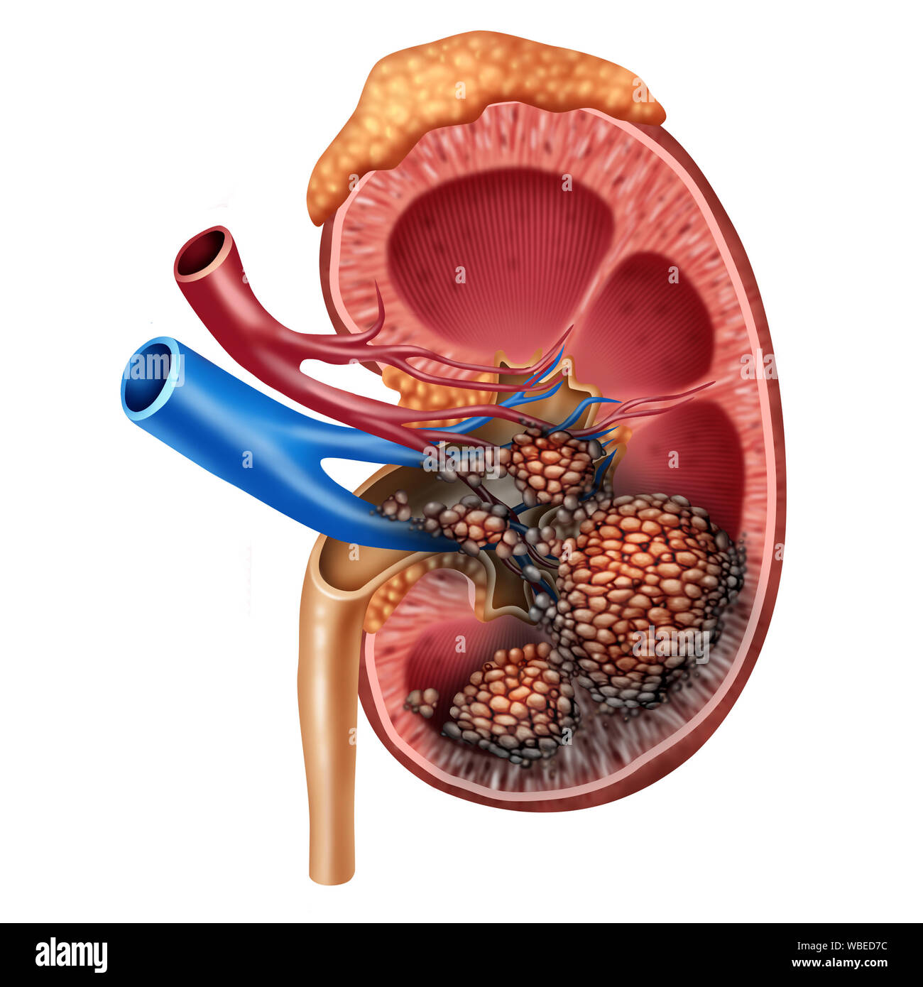 Human kidney cancer anatomy medical concept as cancerouse cells in a human body attacking the urinary system and renal anatomy. Stock Photo