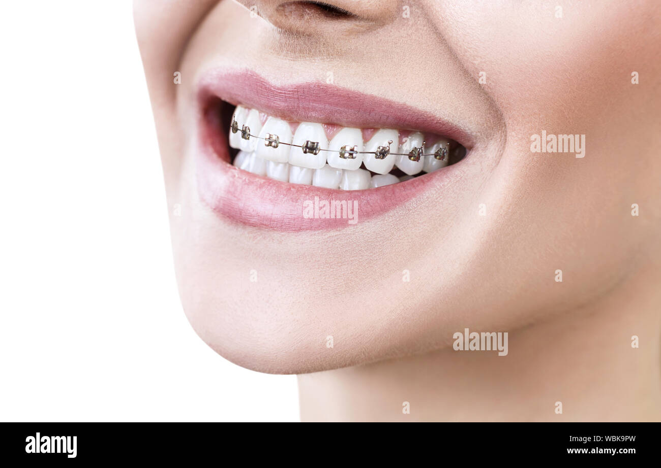 Young woman smiling with braces on teeth. Isolated on white. Stock Photo