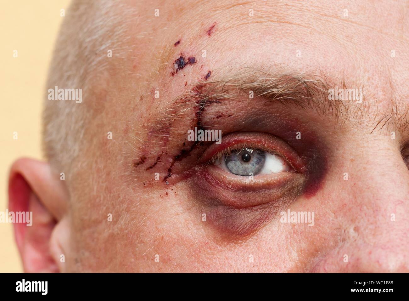 Male eye with a large purple bruise. Biting dog on face. Eye injury. Large bruising on the male eye. Treatment of injuries. Boxer eye. Stock Photo
