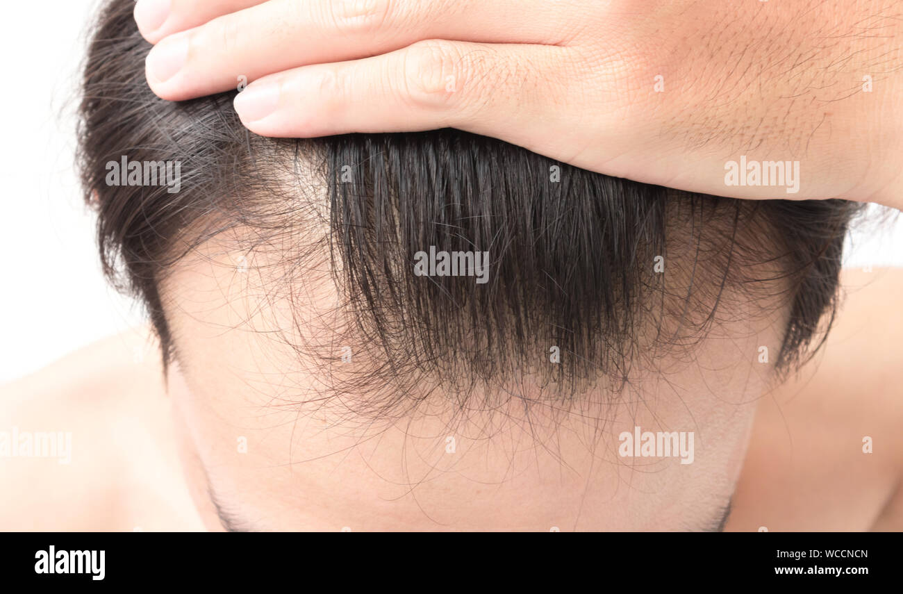 Cropped Image Of Man Showing Balding Hair Stock Photo