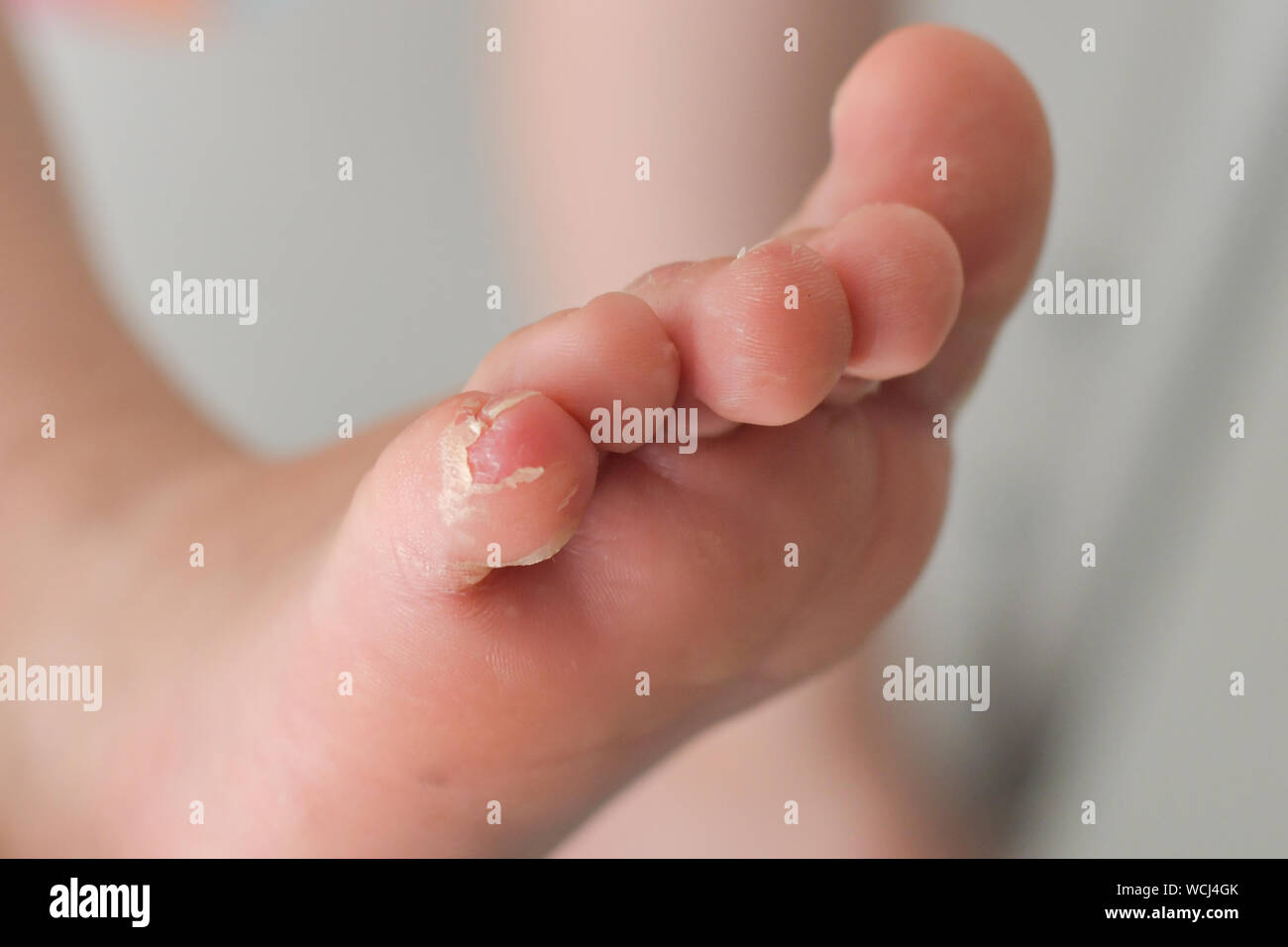 Enterovirus Foot Hand Mouth Skin Peeled Off On The Body Of A Child Cocksackie Virus Stock Photo Alamy