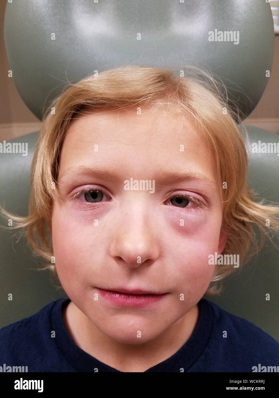 Swollen and sore eyes hires stock photography and images Alamy
