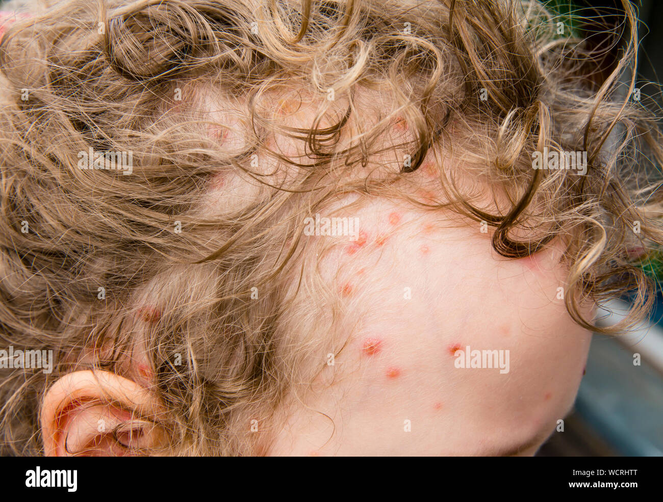 4 days old Chickenpox blisters also known as varicella on 5 year old girl head and in hair. Highly contagious skin disease concept. Stock Photo