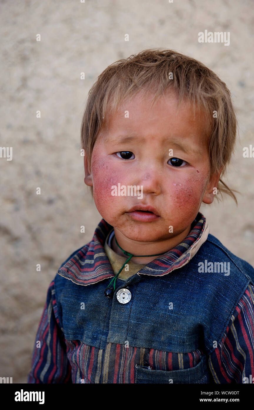 A little girl with frostbitten cheeks in the village of Rag-e-Shad, on the outskirts of Bamyan city, central Bamyan Province, Afghanistan. May 11, 2009. Stock Photo