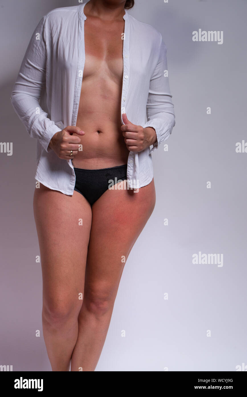 Woman body with serious sunburn damage to skin. Sun can cause serious irritation and painful blisters Stock Photo