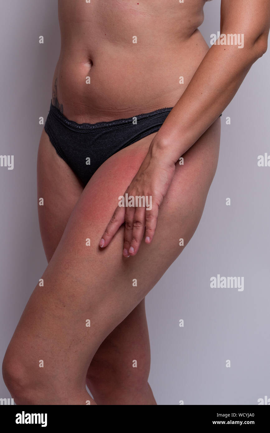 Close up of woman with sunburn on legs