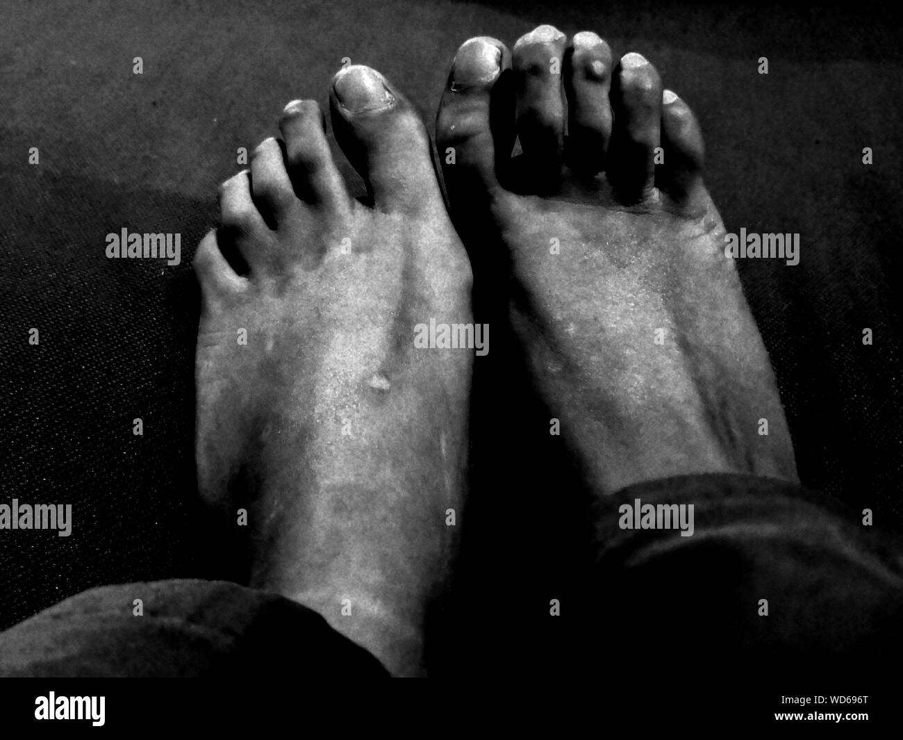 Bad feet hires stock photography and images Alamy