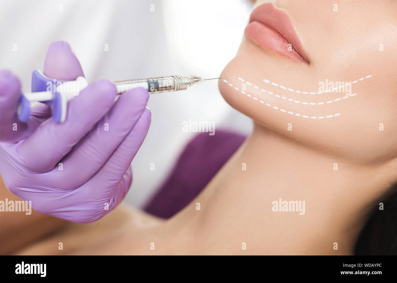 facelift chin and lower face using beauty injection, non surgery.Process lifting face contour close-up Stock Photo